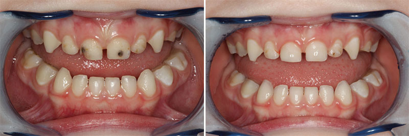 Серебрение молочных зубов Томск Радиостанция N16 клиника нпц стоматология томск